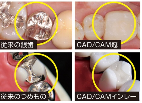 CAD-CAM冠CAD-CAMインレーの適応拡⼤