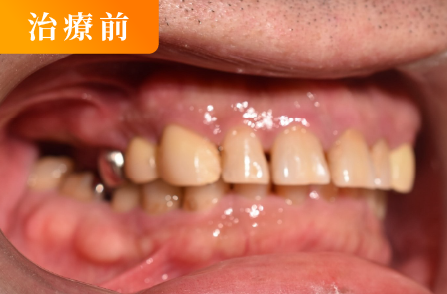 入れ歯治療前（ノンスクラプ）